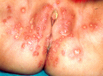 stages of herpes outbreak pictures