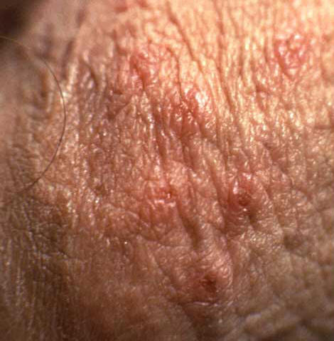 genital herpes outbreaks pictures